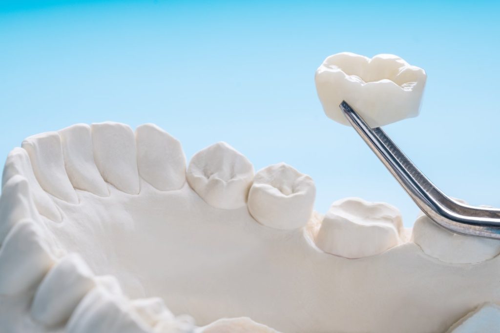 Zirconia Crowns