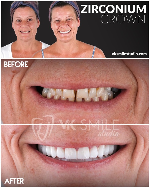 Dental crowns Turkey before after