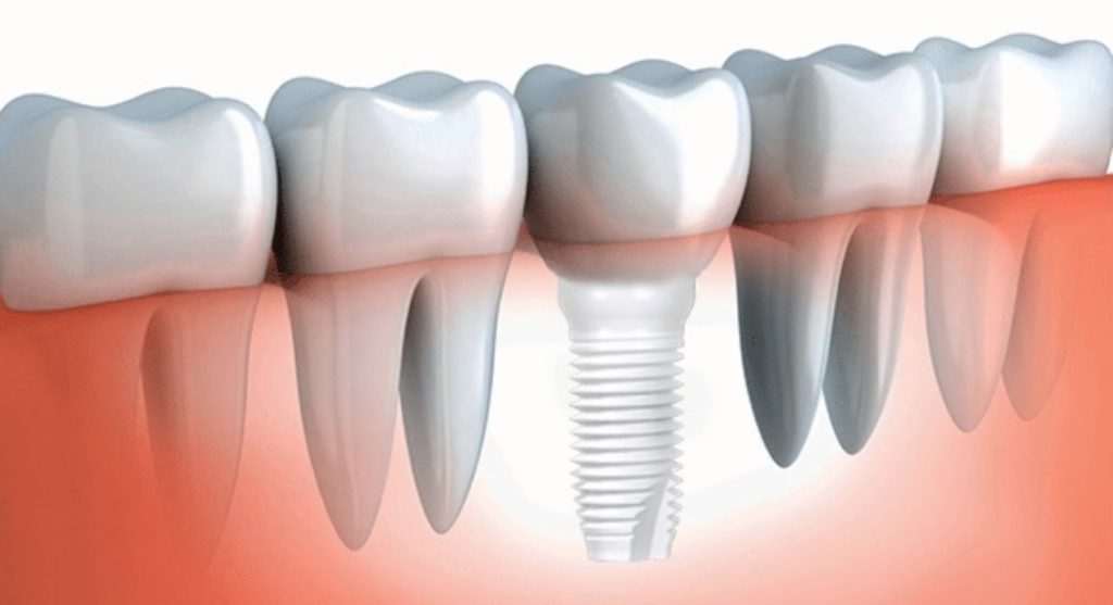 Zirconium Dental Implants in Turkey